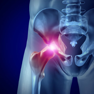 Stryker hip replacement